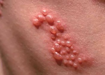 Phương pháp chữa zona thần kinh hiệu quả và cách ngăn ngừa bệnh