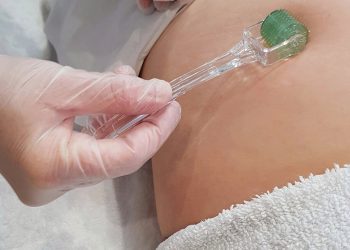 Chuyên gia da liễu tư vấn: Lăn kim có trị được rạn da không?