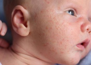 Cha mẹ nên biết: trẻ nhỏ bị nổi mụn li ti là bị làm sao và xử lý thế nào