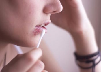 ​Cách điều trị viêm da do virus Herpes hiệu quả