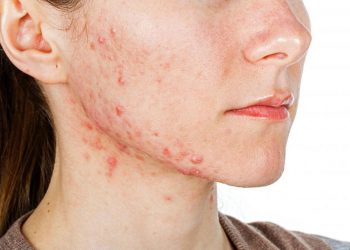Bí quyết đánh bay mụn quai hàm cực hiệu quả