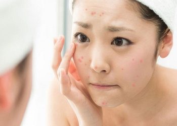 Nổi mẩn đỏ sau khi dùng thuốc trị mụn có nguy hiểm không?