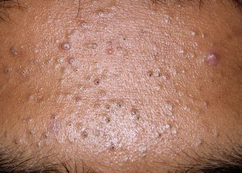 Bật mí cách trị tắc lỗ chân lông tại nhà cực kỳ hiệu quả