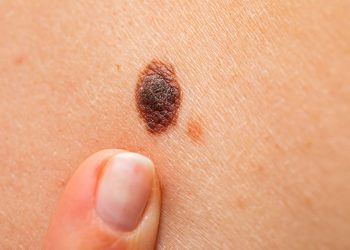 Cách phân biệt nốt ruồi bất thường ai cũng nên biết