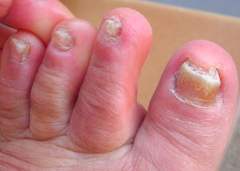 Có thể điều trị bệnh nấm móng dứt điểm hay không?