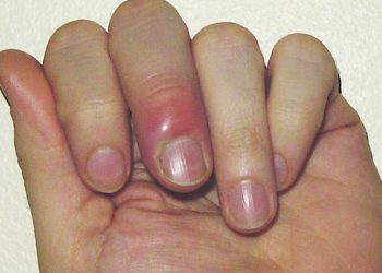 Đừng chủ quan với tình trạng viêm da quanh móng