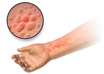 Những bệnh da liễu thường gặp vào mùa nóng bạn không nên chủ quan