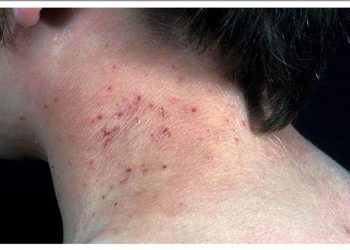 Những điều người bệnh viêm da tụ cầu đang mang thai nên biết