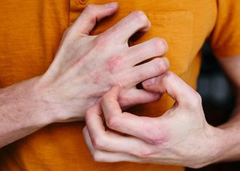 ​Phương pháp điều trị viêm da dị ứng ở tay chân hiệu quả