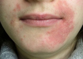 Tình trạng viêm da dị ứng ở mặt có đáng lo ngại không?