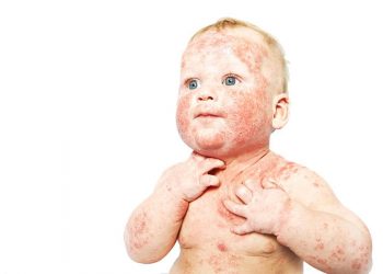 Viêm da dị ứng ở trẻ em ảnh hưởng như thế nào tới sức khỏe?