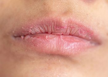 Giải đáp: Nên làm gì khi da môi bong tróc?