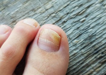 ​Giải pháp điều trị móng chọc thịt an toàn – hiệu quả