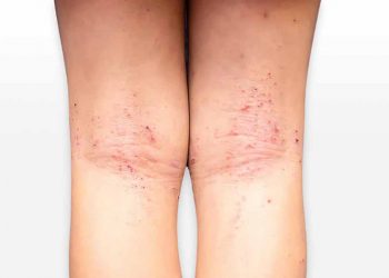 ​Có thể phòng ngừa bệnh viêm da cơ địa khi trời lạnh hay không?