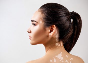 Bạch biến có nguy hiểm không? Cơ hội điều trị bệnh bạch biến