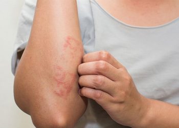 Viêm da dị ứng tắm lá gì để bệnh nhanh khỏi?