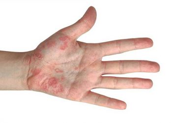 Cảnh báo những bệnh lý khiến da bị nổi mụn nước