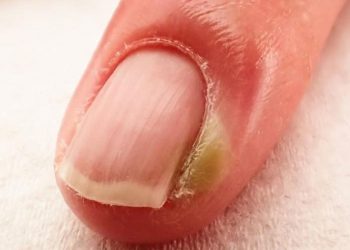 Triệu chứng bệnh chín mé ngón tay và cách phòng ngừa hiệu quả