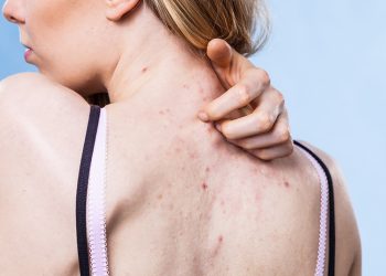 Tìm hiểu các nguyên nhân mụn lưng và cách khắc phục