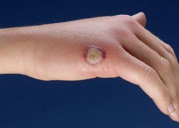 Hoại thư da – những vấn đề nhiều người chưa biết