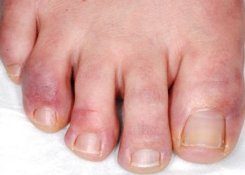 Những gợi ý giúp bạn “đối phó” với bệnh cước chân tay vào mùa đông