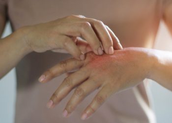 Nguyên nhân gây nổi mề đay và cách phòng ngừa hiệu quả