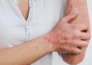 Hé lộ bí kíp điều trị tăng sắc tố sau viêm hiệu quả nhất