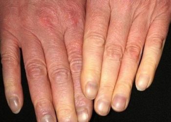 Bệnh cước có nguy hiểm không? Phải làm sao để phòng bệnh hiệu quả?