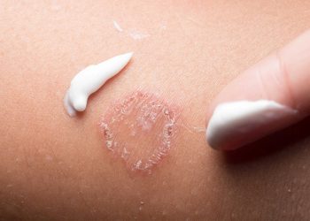 Phương pháp điều trị nấm da bẹn và cách phòng ngừa bệnh tái nhiễm