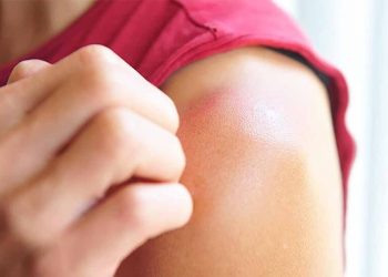 Vì sao nhiều người bị viêm da do ánh nắng và cách phòng ngừa