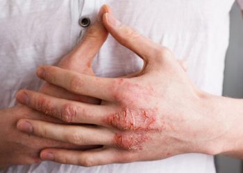 Viêm da tiếp xúc: nguyên nhân và phương pháp điều trị
