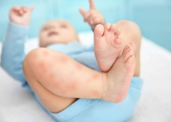 Viêm da tiết bã ở trẻ biểu hiện là gì và cách điều trị