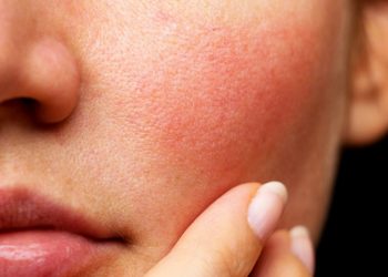 Cải thiện tình trạng da khô ngứa vào mùa đông như thế nào?