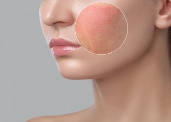 Làm gì khi bị dị ứng mỹ phẩm? Cách xử trí và phòng tránh hiệu quả