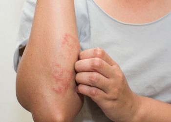 Các bệnh về da khi thời tiết chuyển mùa thường gặp nhất