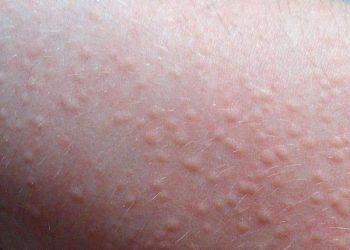 Đi tìm lời giải cho băn khoăn nổi mề đay có lây không?