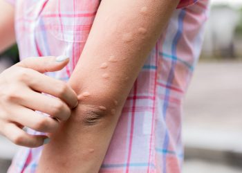 Nổi mày đay do lạnh là gì và cách chữa mày đay do lạnh