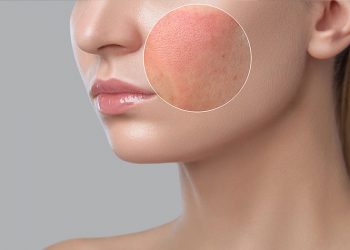 Tìm hiểu các thông tin về dị ứng da mặt