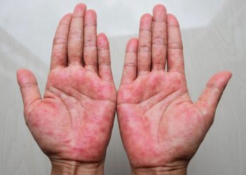 Viêm da cơ địa kiêng ăn gì? Những loại thực phẩm người bệnh cần tránh