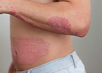 ​Bệnh vảy nến là gì? Nhận biết và điều trị bệnh nhanh chóng, hiệu quả