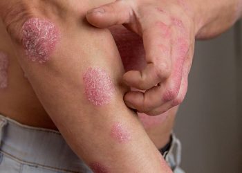 ​Eczema là bệnh gì? Nguyên nhân, biểu hiện và cách phòng bệnh