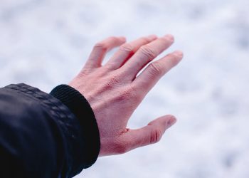 ​Bỏng lạnh là gì? Nguyên nhân khiến da bị bỏng lạnh?