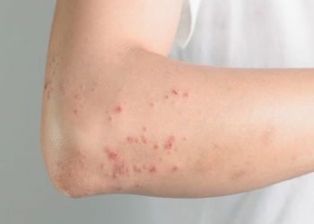 5 cách chữa nổi mề đay ngay tại nhà an toàn, hiệu quả