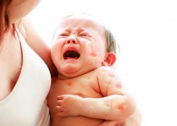Phân loại mề đay và các cách trị nổi mề đay an toàn