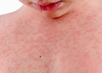 Da nổi mẩn đỏ ngứa là bị làm sao và xử lý thế nào?