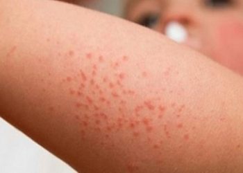 Lý giải căn nguyên gây ra hiện tượng da nổi mẩn đỏ không ngứa
