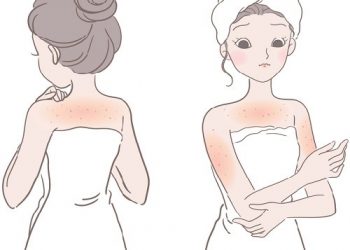 5 cách điều trị viêm nang lông hiệu quả tại nhà