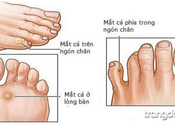 Bàn chân bị chai sần phải làm sao?