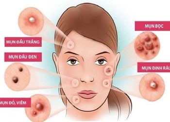 Nặn mụn tại nhà có an toàn không?