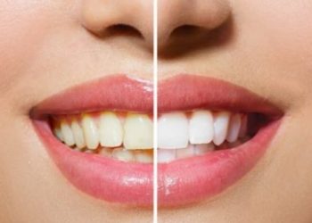 Cách đánh bay vết ố vàng trên răng ngay tại nhà bằng nguyên liệu hoàn toàn tự nhiên